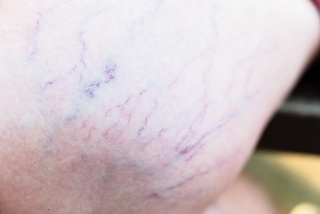 Problemele vasculare: 10 semne de alarmă